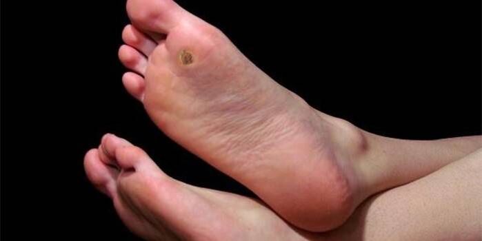 Plantar wart (thorn) on the foot