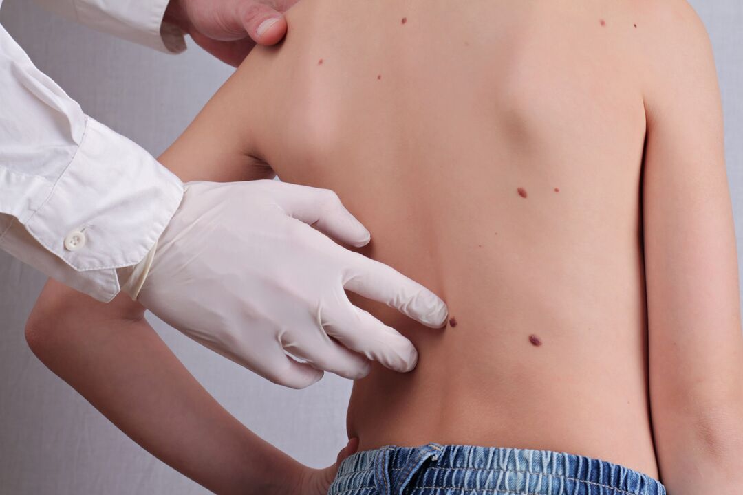 The dermatologist conducts a clinical examination of a patient with papillomas on the body