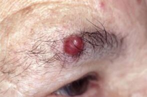 Eyebrow papilloma