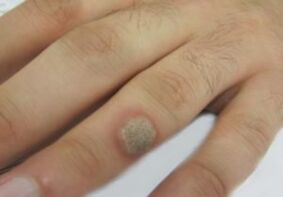 Papilloma on the brush