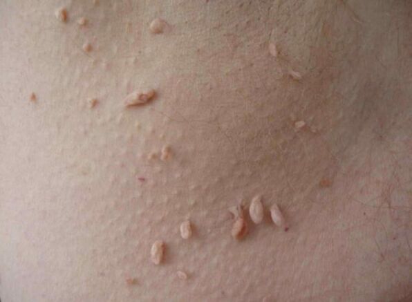 Acrocodes on the skin