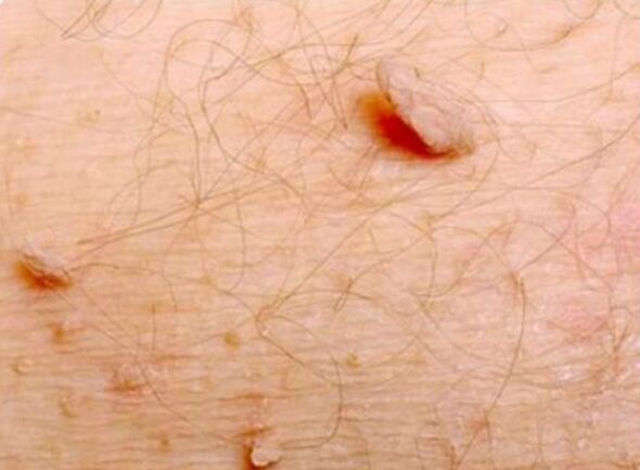 Acute papillomas on the human body