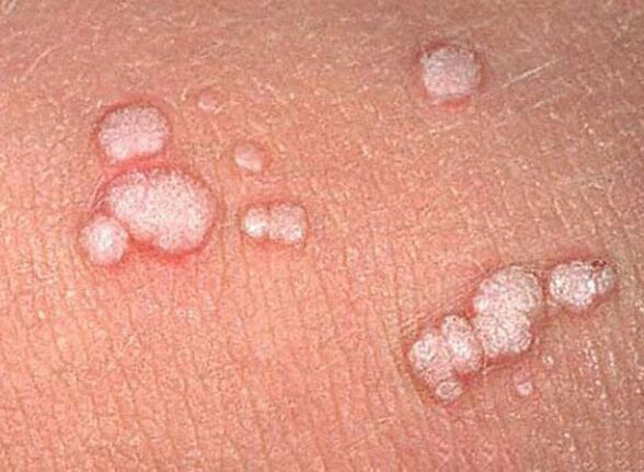 Papillomas on the human body