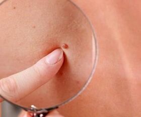 manifestations of the human papillomavirus