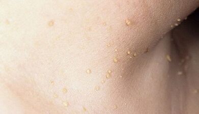 risk of developing papillomatosis of the neck