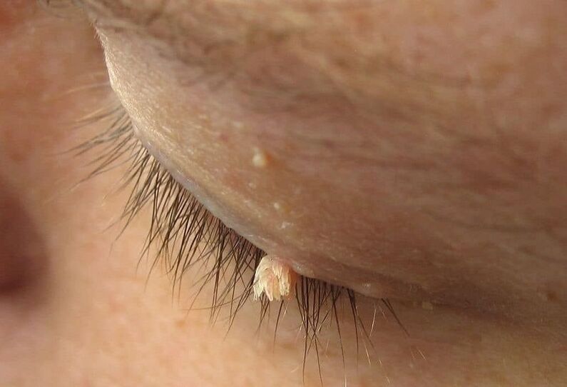 filiform wart on the eyelid