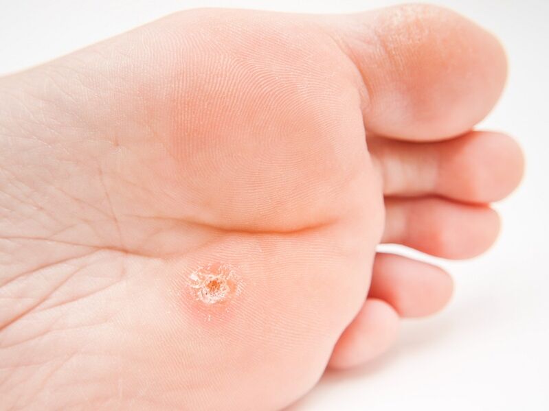 plantar wart on foot