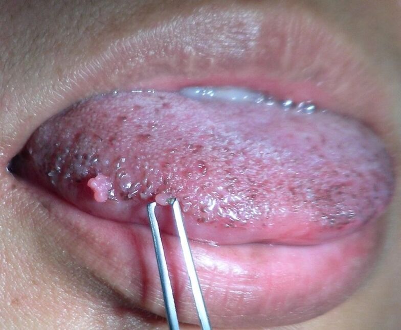 tongue warts