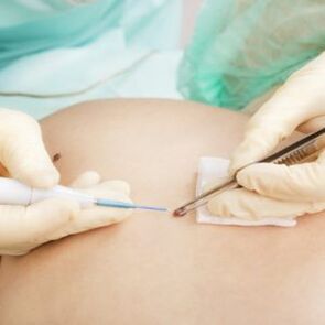 removal of the papilloma by a surgeon