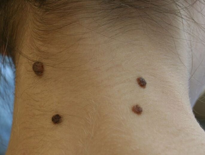 what papillomas look like on the neck