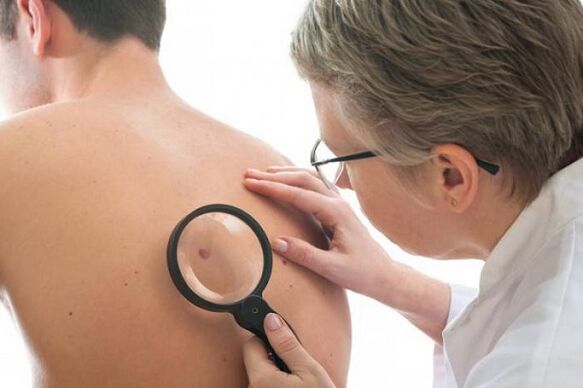 a doctor examines a papilloma on the back