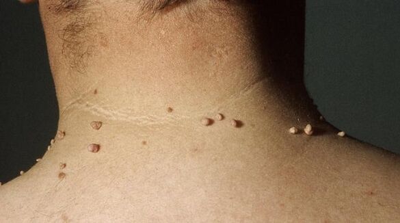 filiform papilloma of the neck