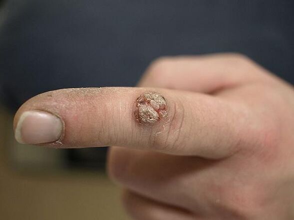 finger papilloma