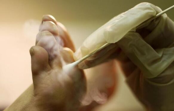 freezing the papilloma on the leg