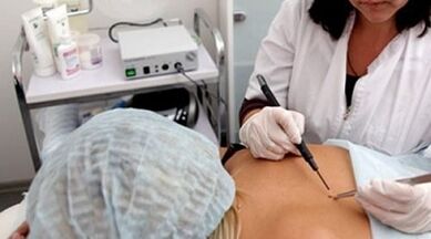 Electrocoagulation as a wart removal method